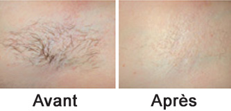 traitement lumière pulsée intense IPL, traite la couperose, épile, réduit les taches pigmentaires, IPLImpulsion 3