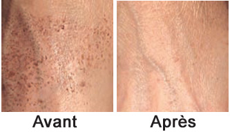 taches pigmentaires, taches brunes sur la peau, lentigo, taches de vieillesse, IPLIpusion 2